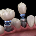 Implant-Restoration-400x241.jpg